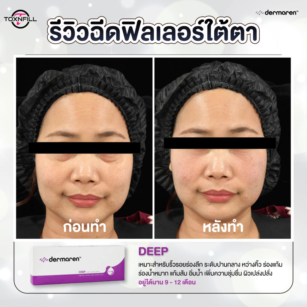 dermaren รีวิว