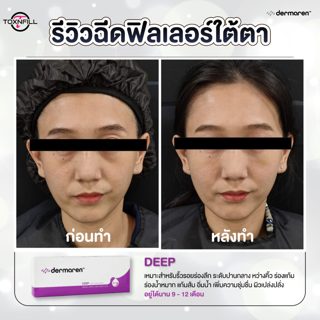 dermaren รีวิว