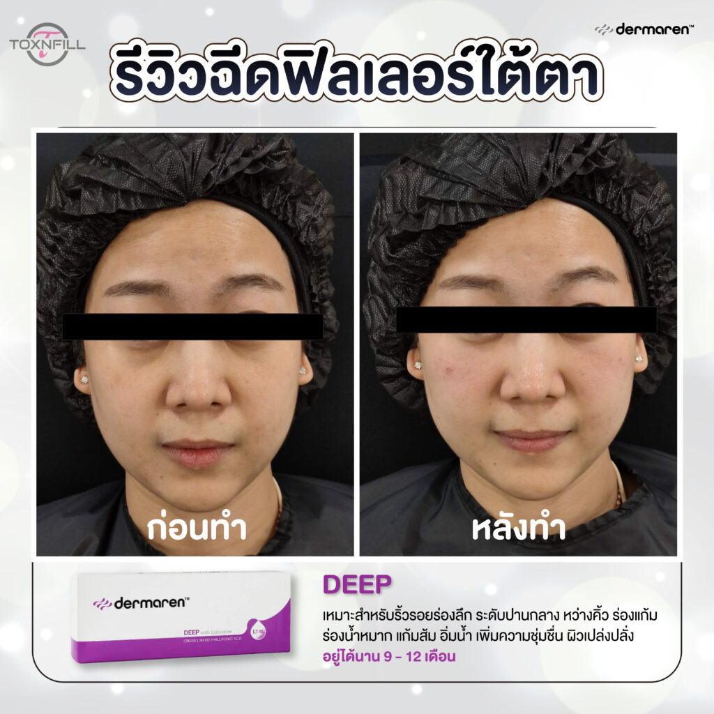 dermaren รีวิว