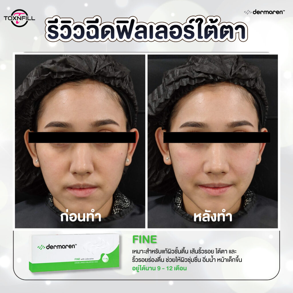 dermaren รีวิว